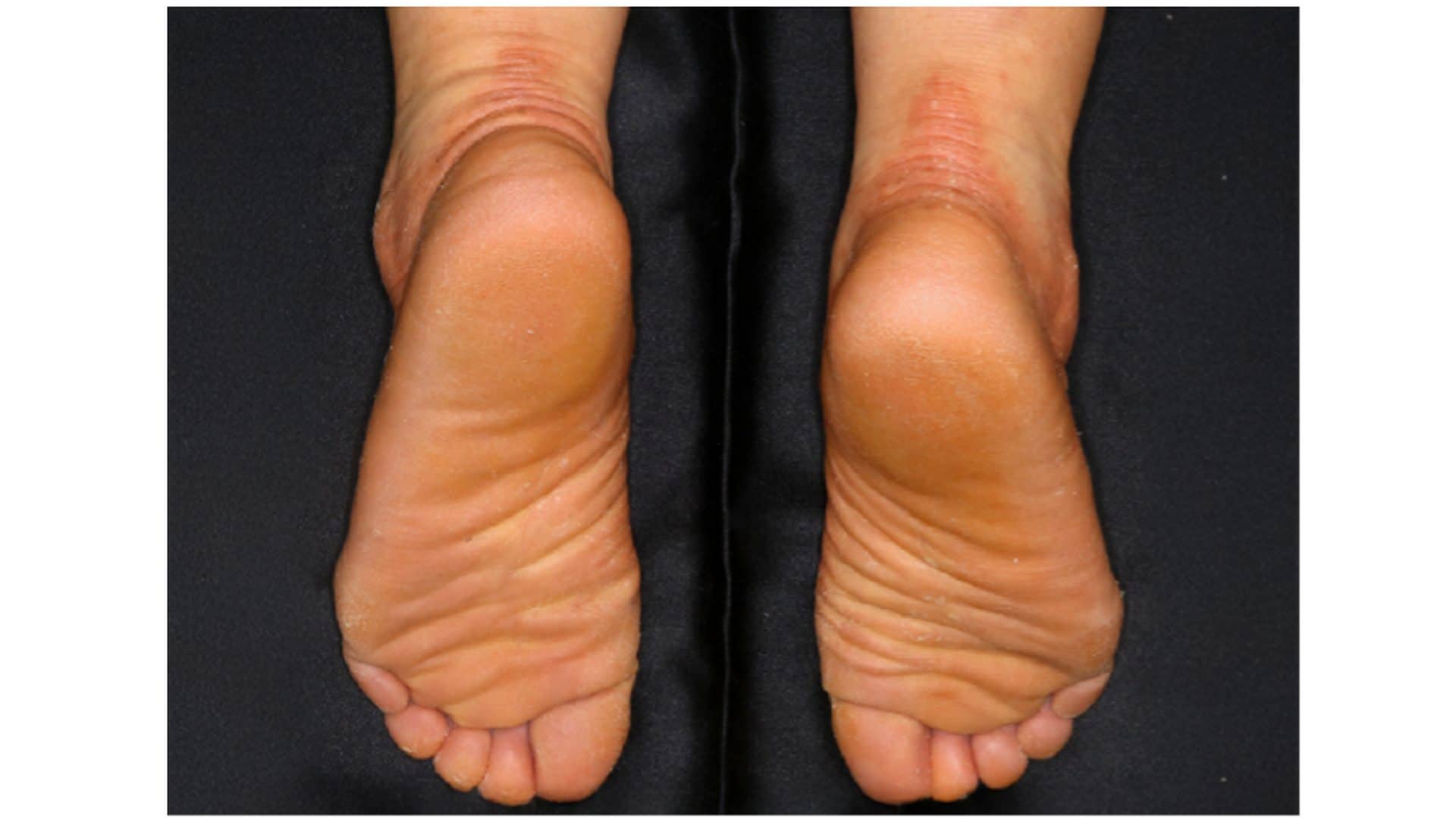 Svelata la causa di un tipico cattivo odore dei piedi: ora c'è un modo per combatterlo