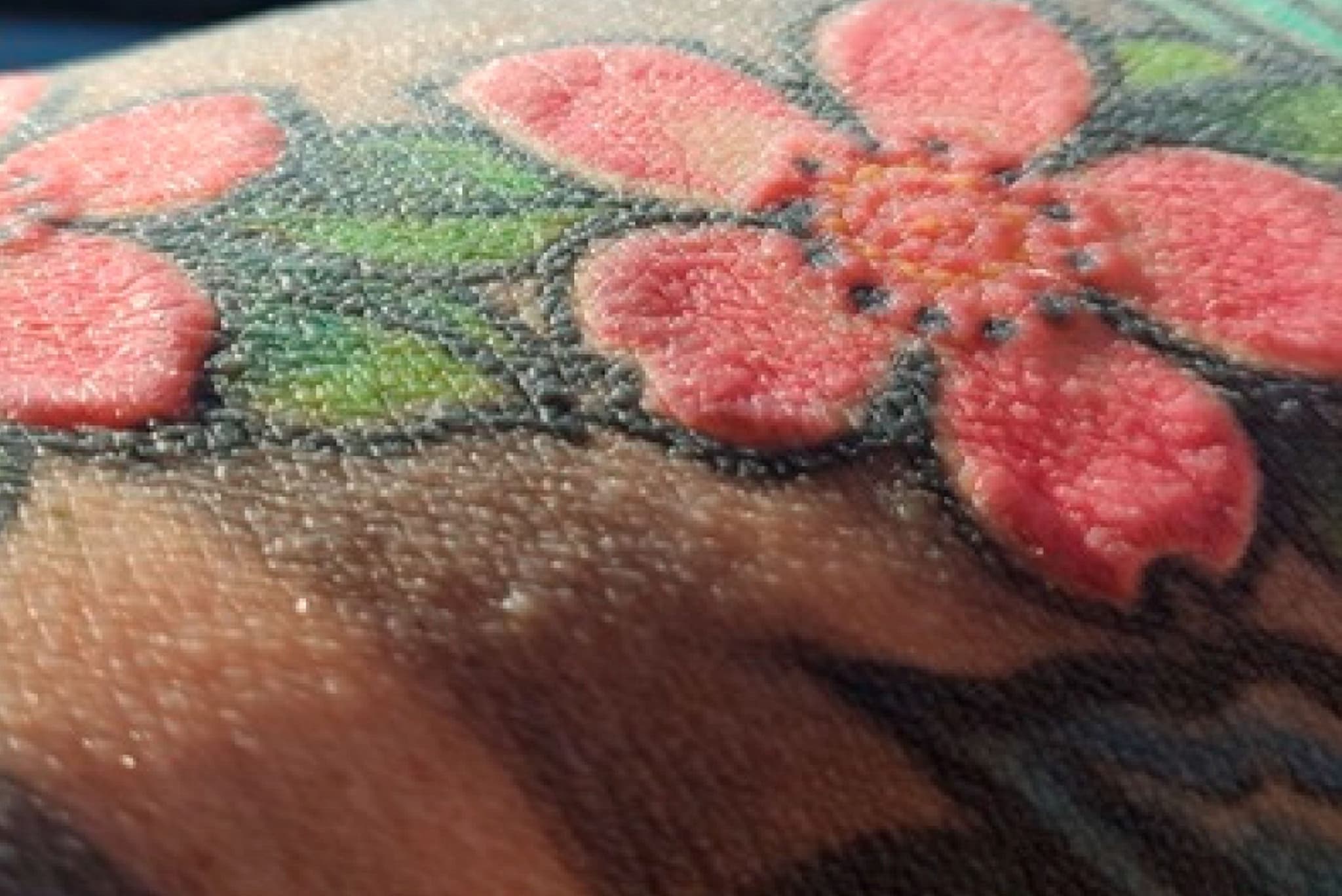 Sintomi insoliti mesi dopo un tatuaggio: la storia di un 30enne costretto alla rimozione chirurgica