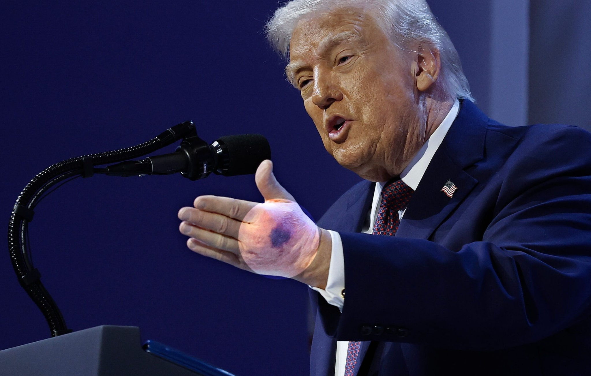 Cosa c'è dietro il livido sulla mano di Trump: il fact-checking del cardiologo sulle sue parole