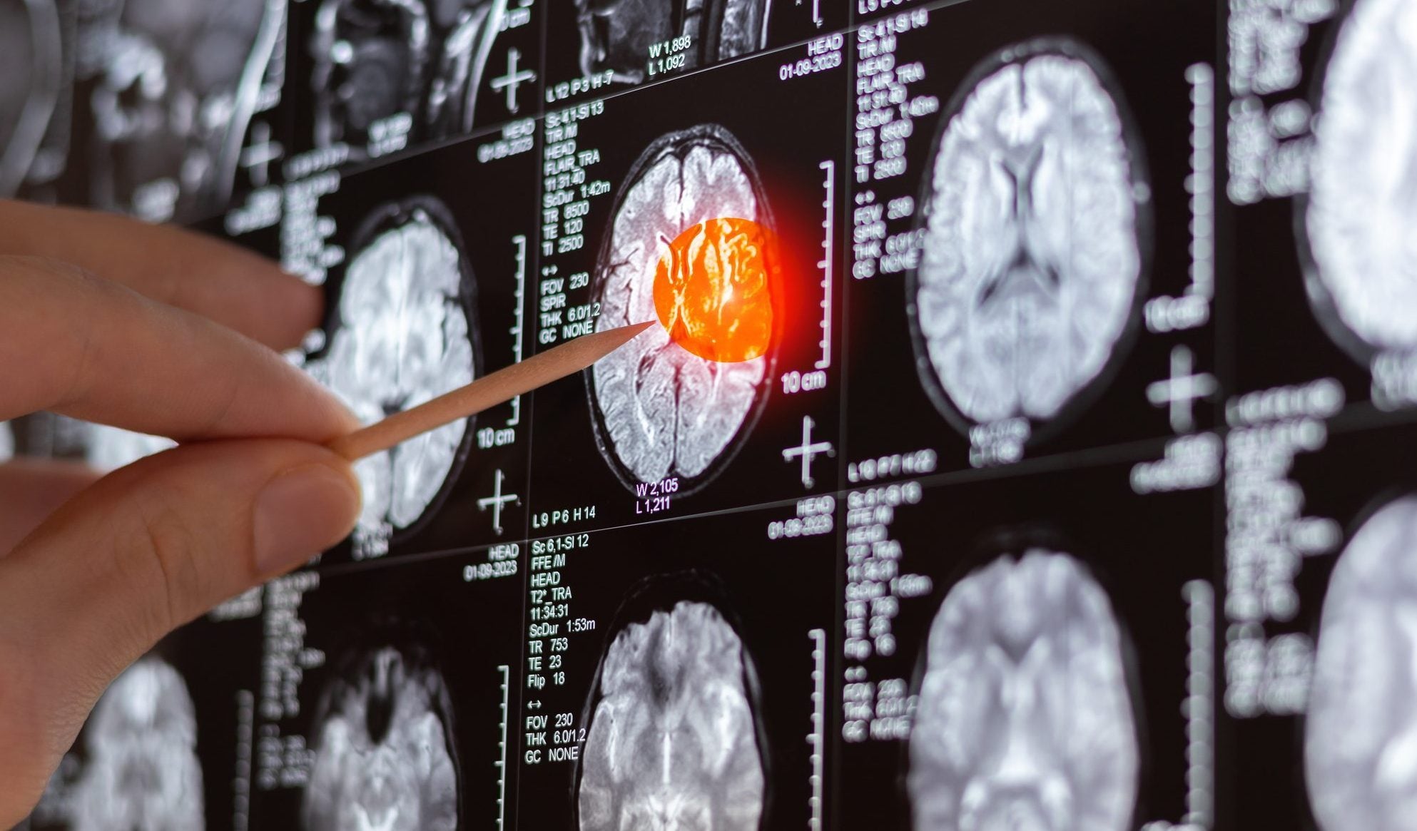 Fino alle radici invisibili del tumore, Bello: "Con la nostra tecnica proteggiamo il cervello sano"