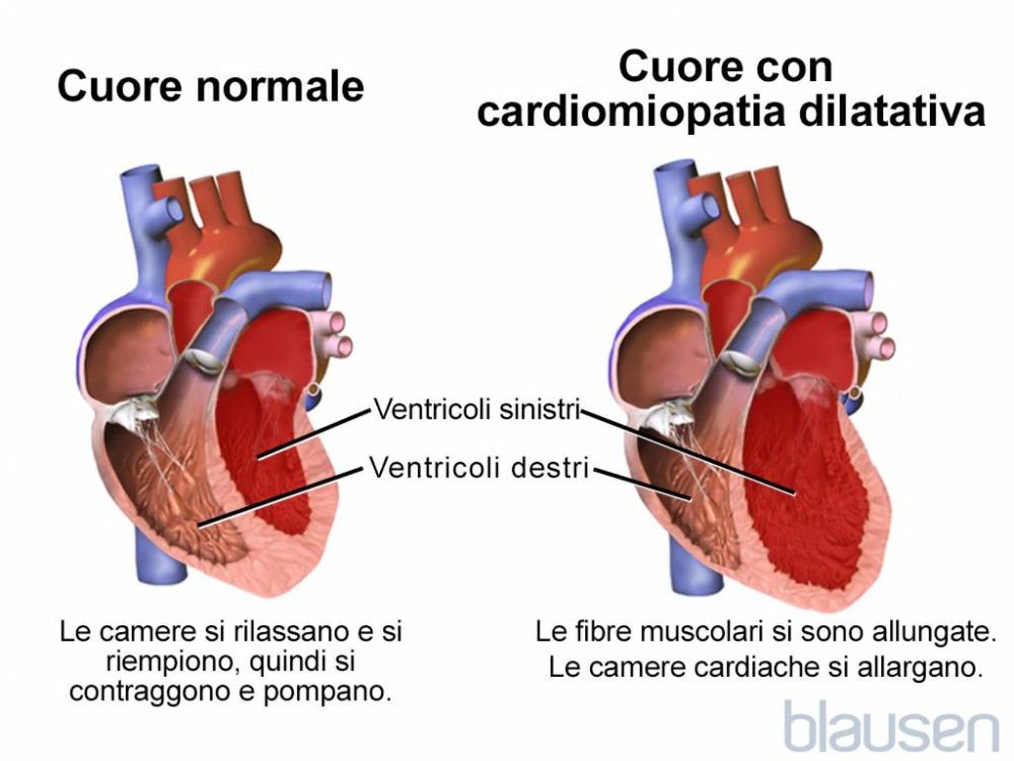 Confronto tra cuore normale e cuore affetto da cardiomiopatia dilatativa: si osserva la dilatazione del ventricolo sinistro che compromette la riduzione della funzione di pompa. Credit: Blausen Medical / MSD Manuals