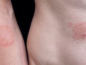 Infezione da fungo emergente si diffonde negli USA, decine di casi: sintomi e trasmissione della TMVII