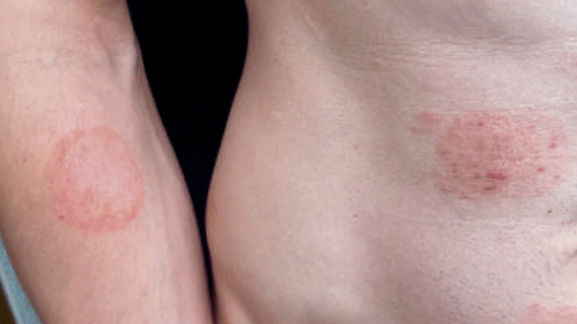 Infezione da fungo emergente si diffonde negli USA, decine di casi: sintomi e trasmissione della TMVII