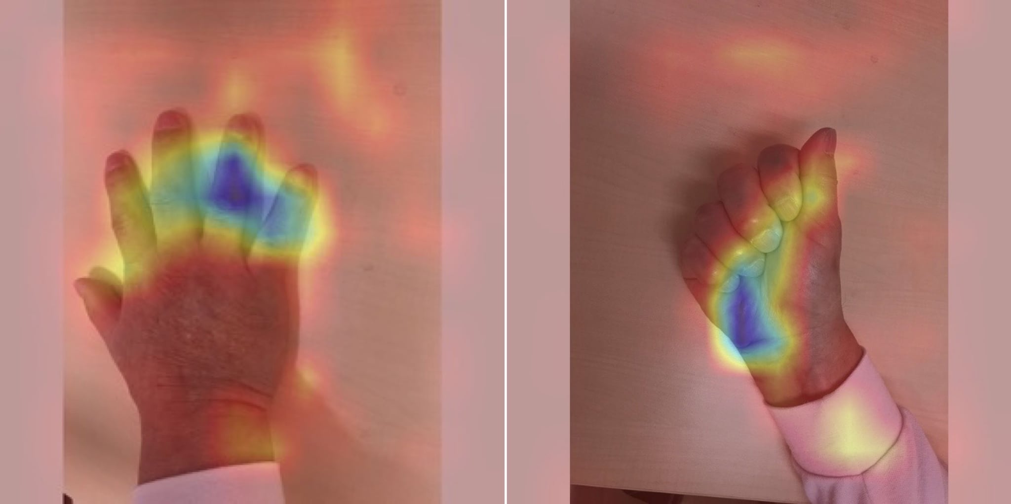 Mappe di attivazione del modello di intelligenza artificiale che evidenziano le aree della mano utilizzate per riconoscere i segni dell’acromegalia. Credit: Università di Kobe.