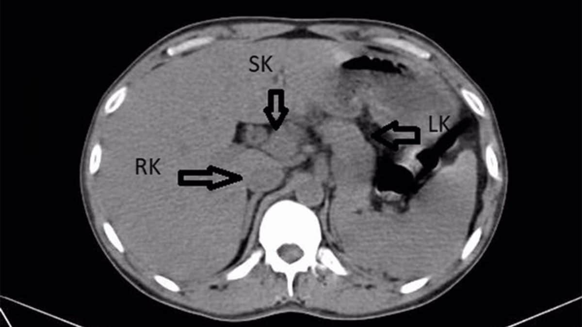 La TC dell’addome dell’uomo di 41 anni mostra un rene soprannumerario (SK) fuso al rene destro (RK), formando una struttura a ferro di cavallo. Il rene sinistro (LK) è separato. Credit: Jawaharlal Nehru Medical College, Datta Meghe Institute of Medical Sciences / Cureus