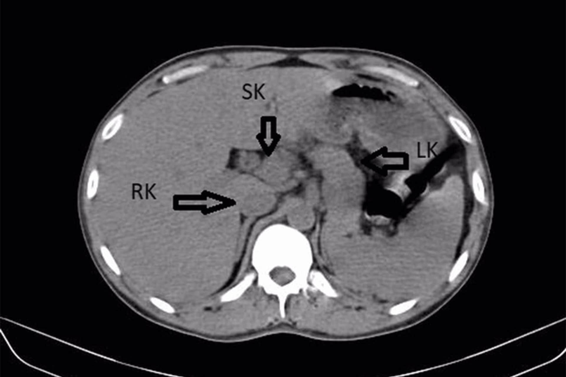 Va in ospedale per febbre e dolori, ma scopre di avere 3 reni: il raro caso clinico