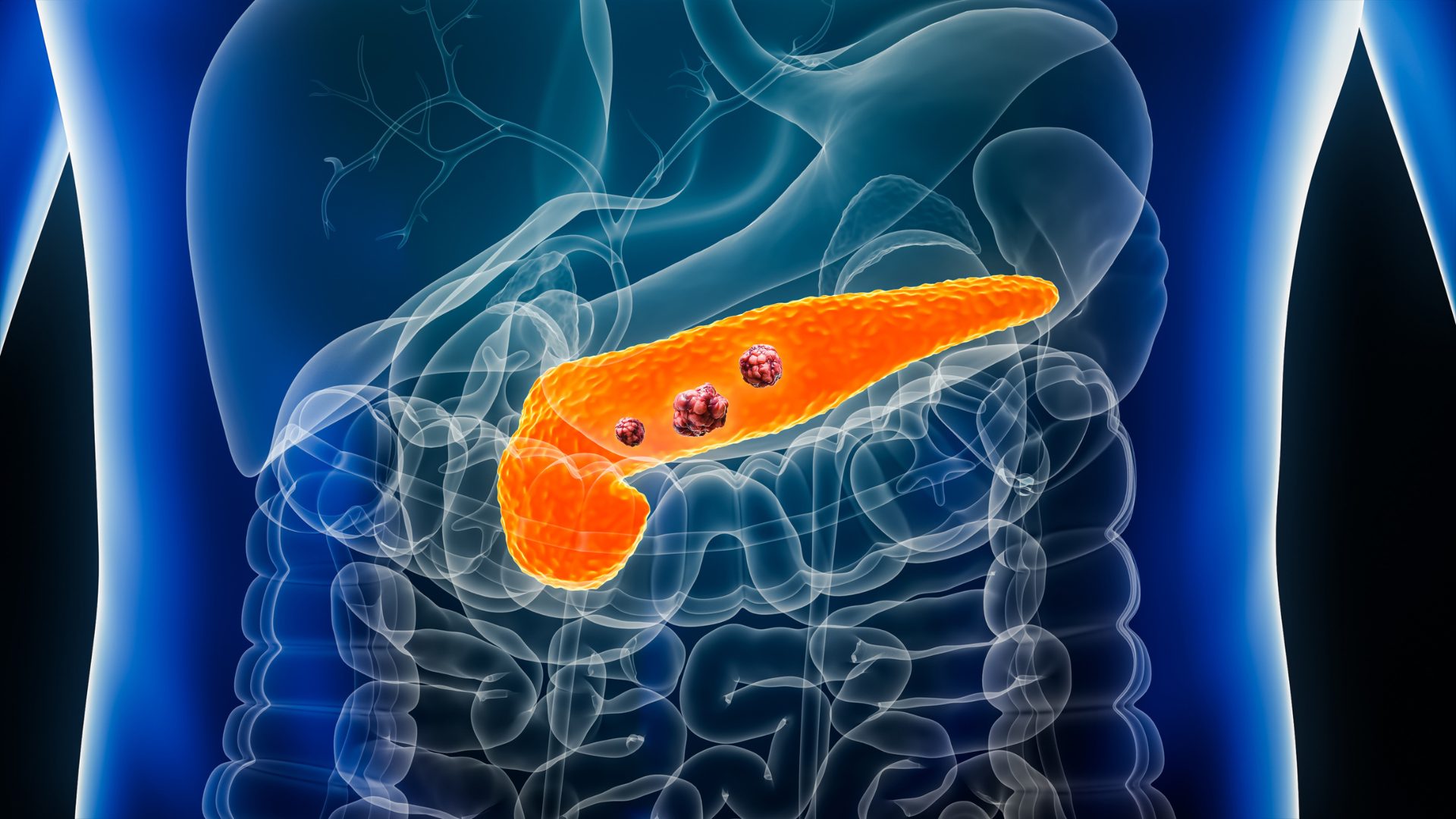 Cancro al pancreas, uno studio sui topi elimina le cellule precancerose prima che diventino tumorali