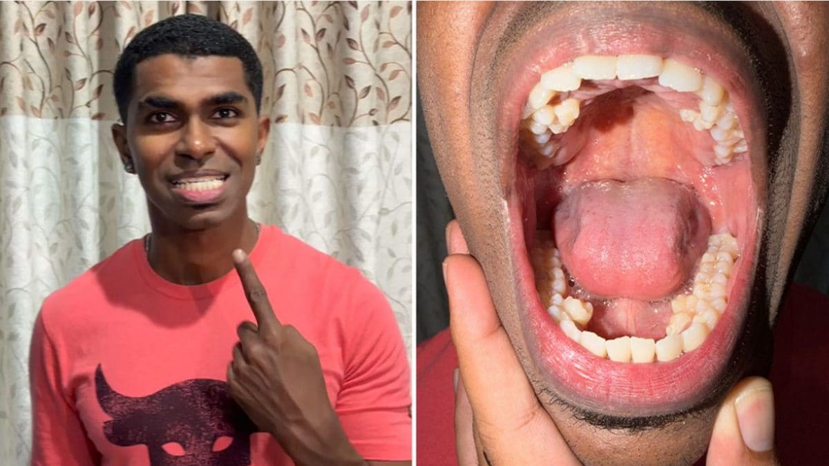Prathab Muniandy, l’uomo con più denti al mondo (42). Credit: Guinness World Records