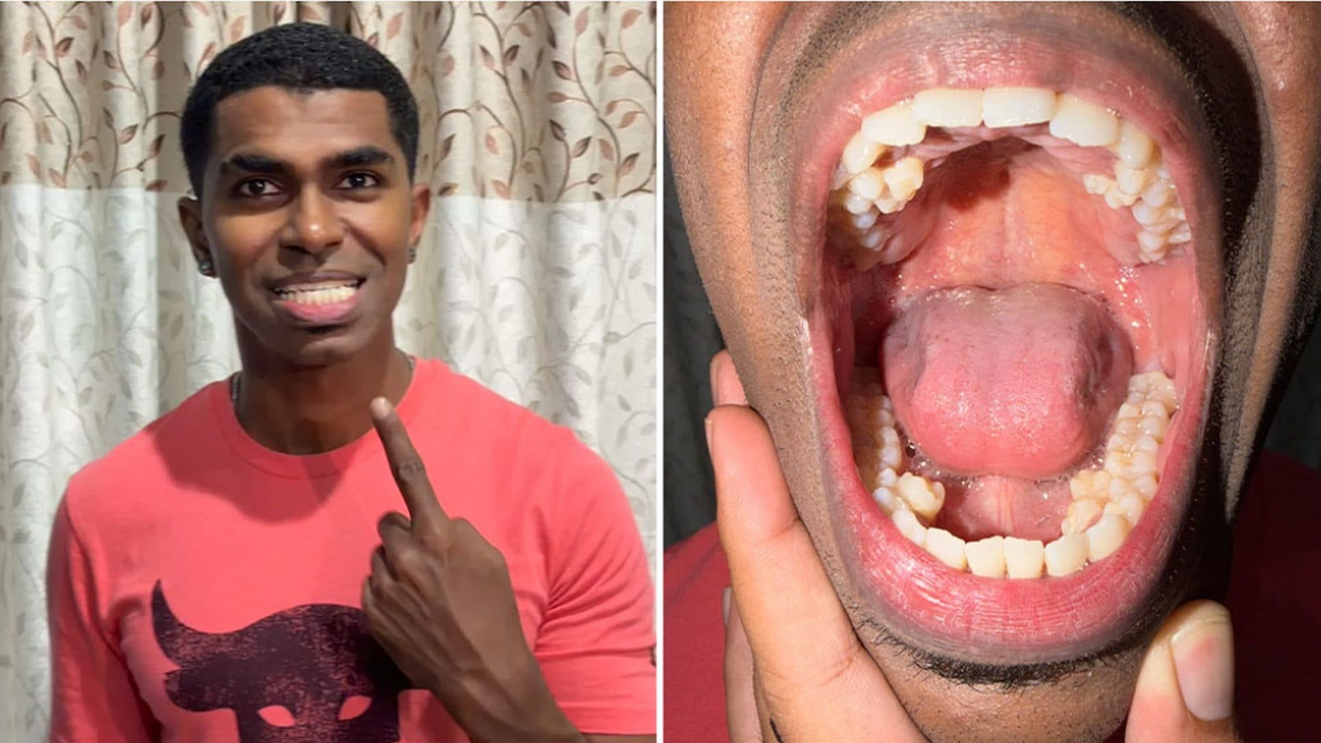 Prathab, l'uomo con più denti al mondo: “Ne ho 42”. Il primato certificato dal Guinness World Records