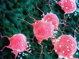 Il cancro al seno sviluppa le metastasi secondo un piano preciso: lo studio dell’Università di Padova