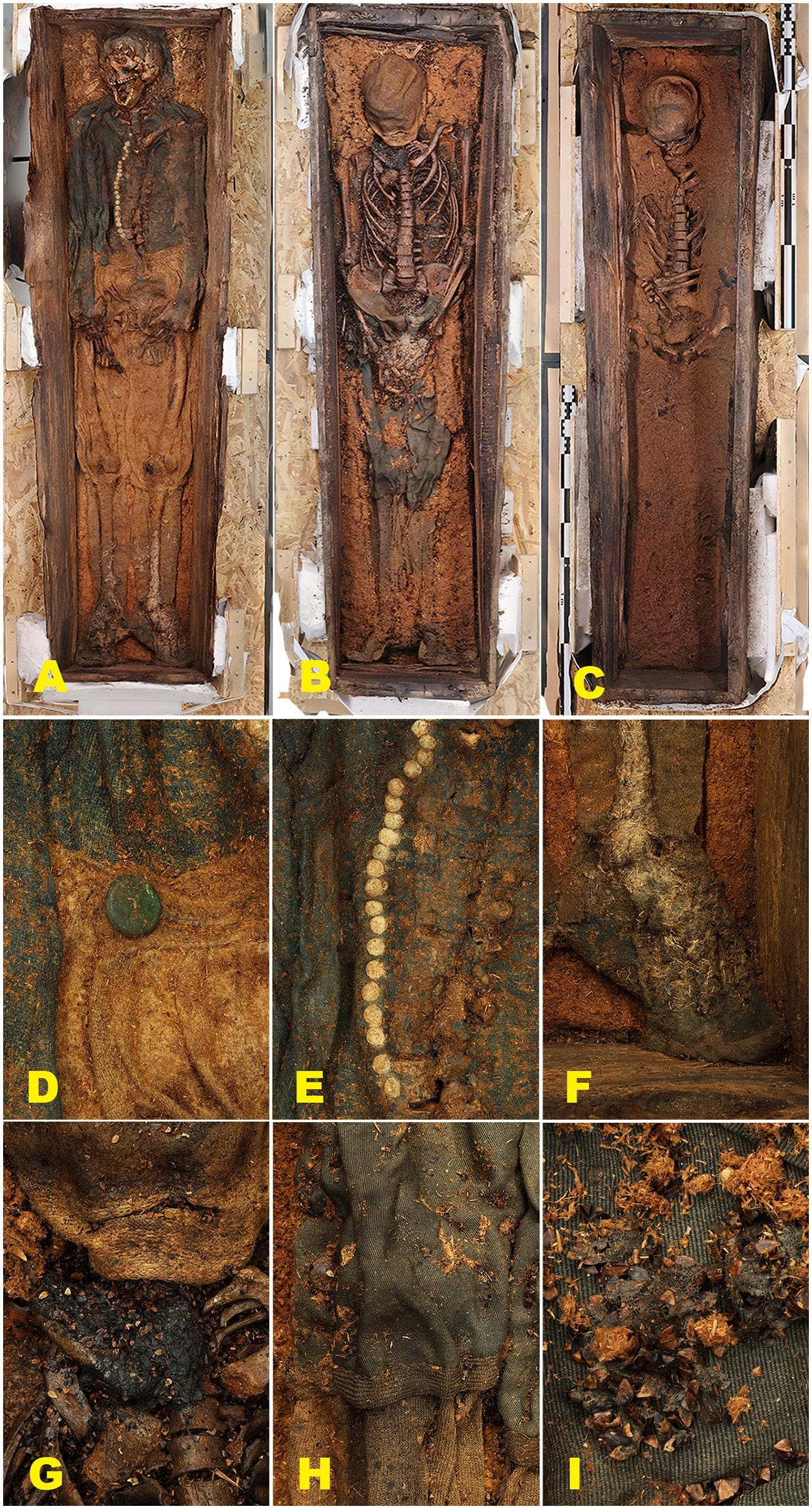 Gli scheletri dei balenieri. Credit: Plos ONE