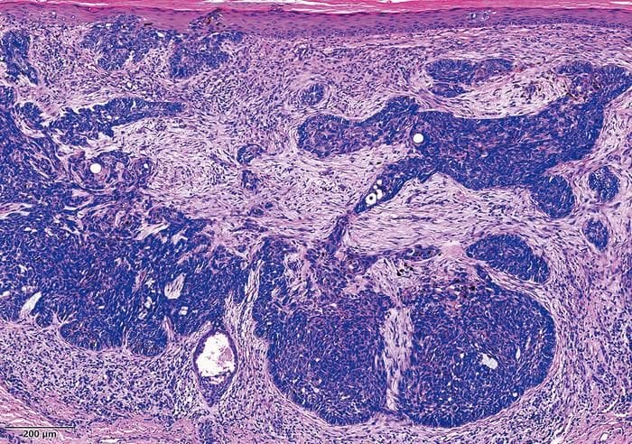 L’esame istologico della biopsia. Credit: Higher Education Press