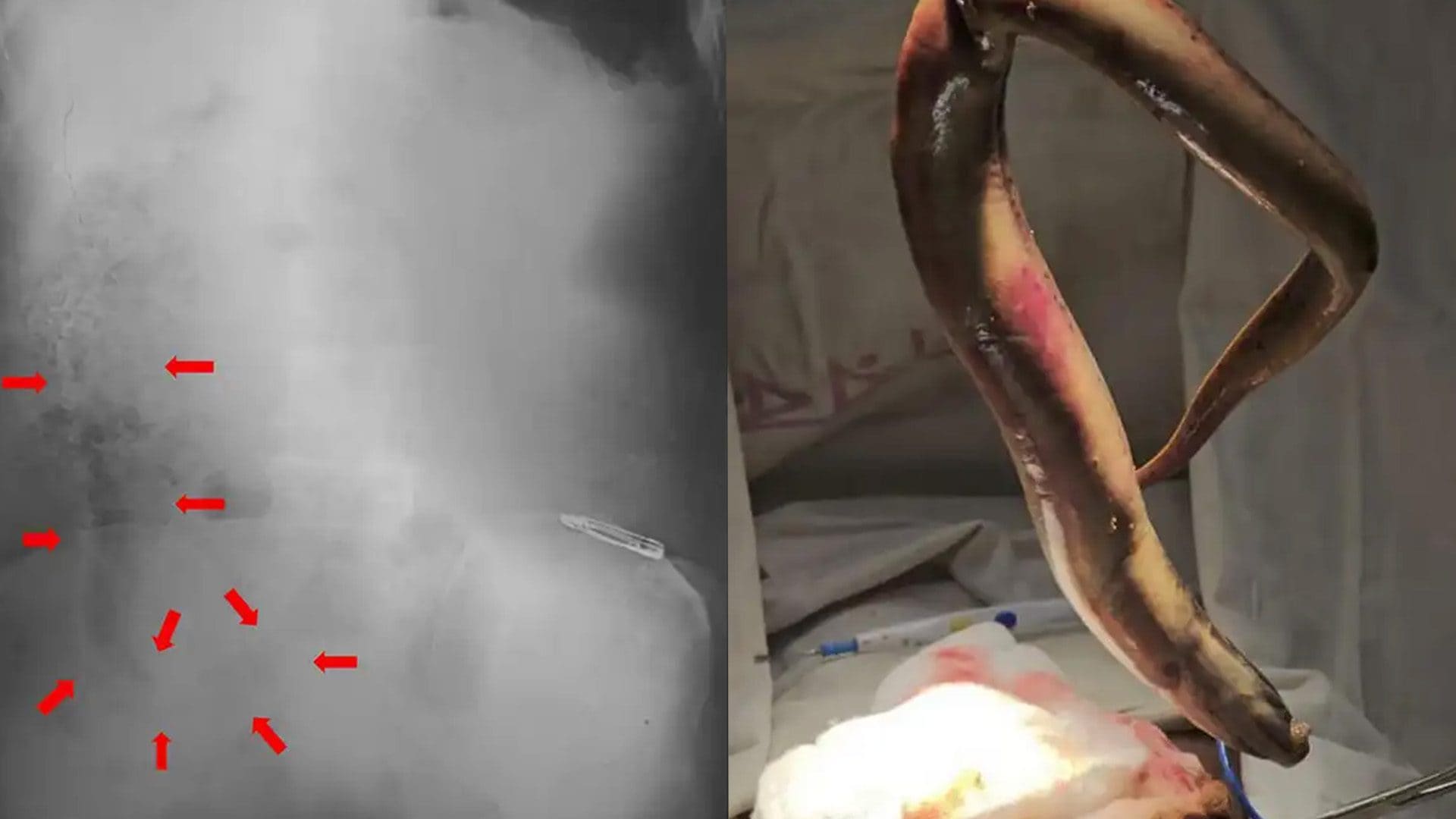 Va in ospedale con dolori atroci all'intestino: trovata anguilla viva di 65 cm. "È entrata nel retto mentre pescavo"