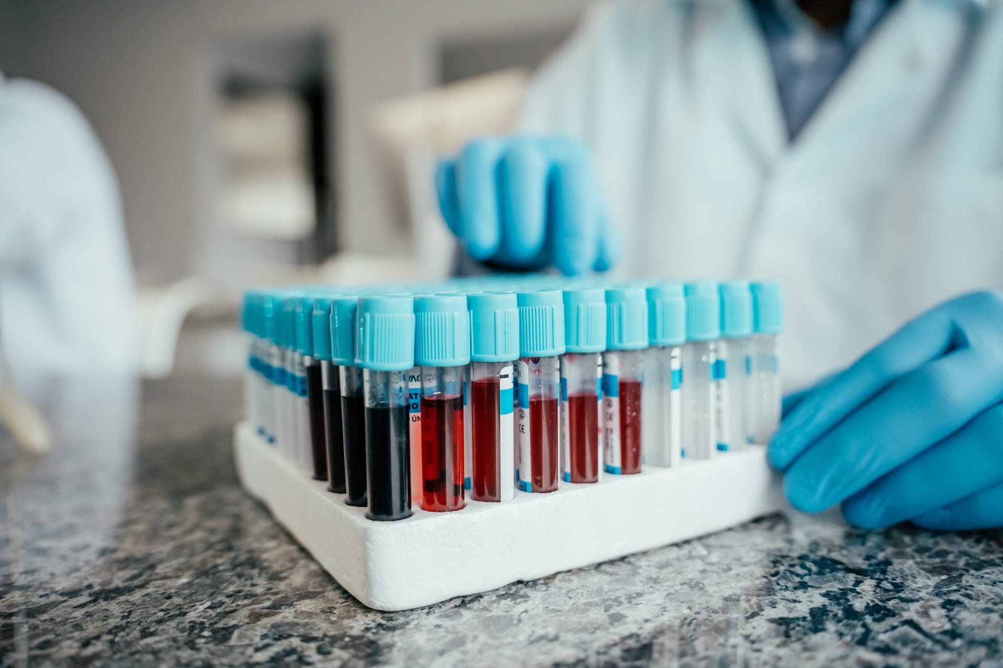 Esame del sangue per l’Alzheimer, con p-tau217 molto alta il rischio sintomi sale al 78% in 10 anni: lo studio su JAMA