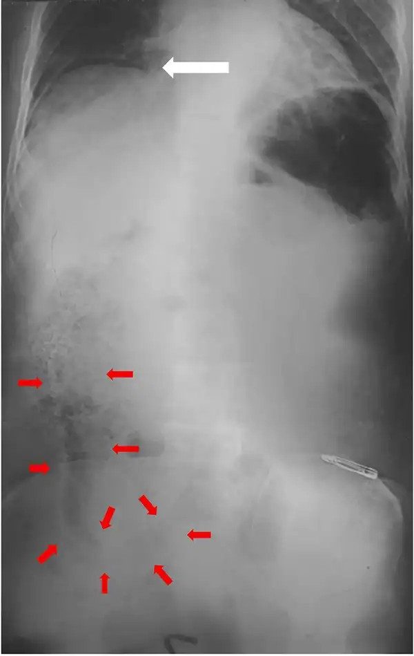 La radiografia mostra la presenza dell'anguilla e di aria nella cavità addominale del paziente. Credit: Mokbul et al., Int. J. Surg. Case Rep., 2026