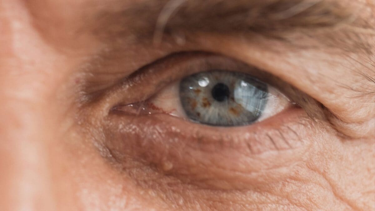 Un normale controllo della vista ha evidenziato un piccolo neo nell'occhio, portando alla diagnosi di melanoma uveale, una forma di tumore intraoculare ad alto rischio di metastasi.