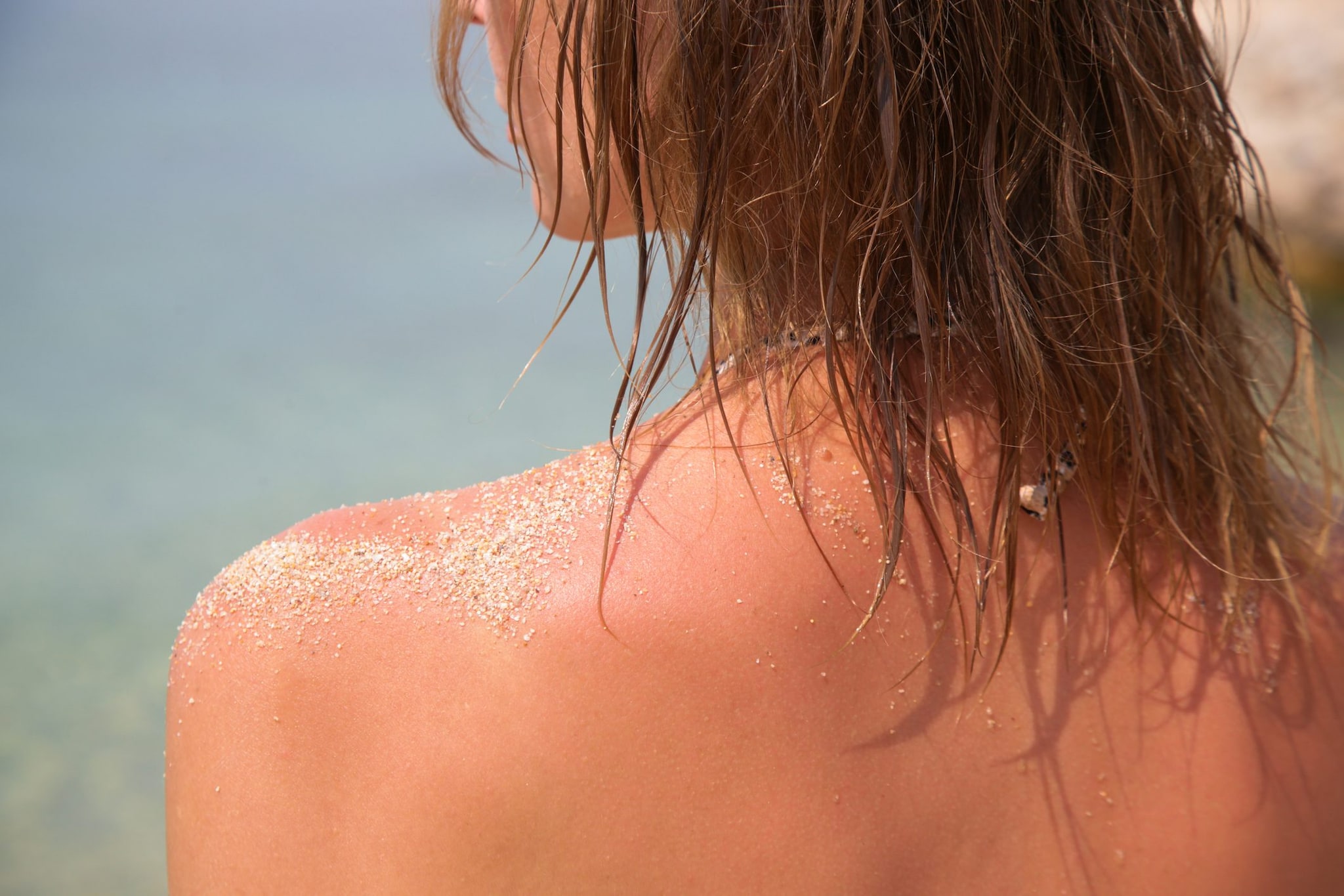 “Una scottatura a Tenerife a 19 anni, credo sia iniziato tutto lì”: Sarah Goldup racconta la diagnosi di melanoma