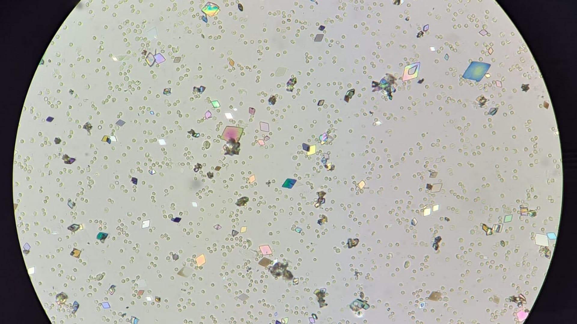 Le foto dei cristalli di acido urico nei campioni di urine, sembrano coriandoli: "Non sempre sono patologici”