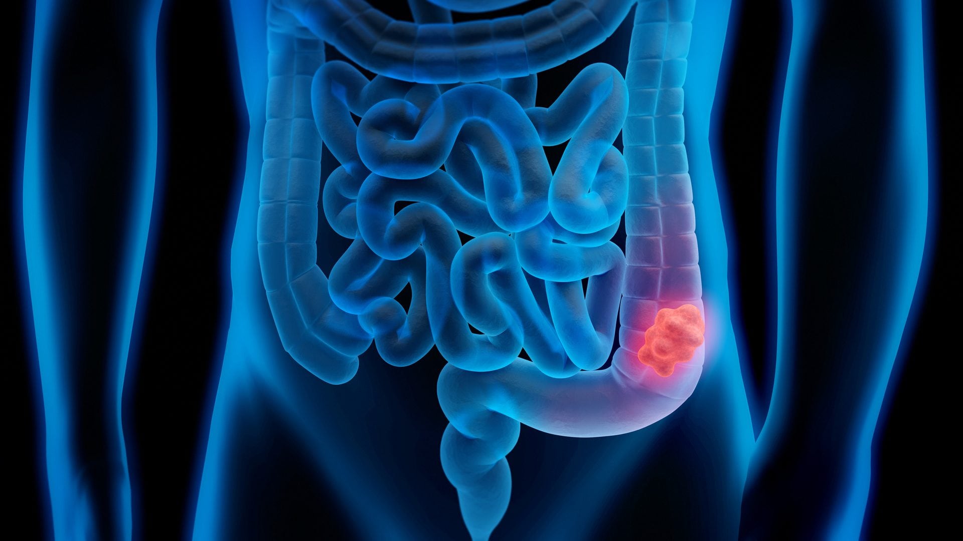 Batterio modificato elimina totalmente oltre il 40% dei tumori al colon-retto in test di laboratorio