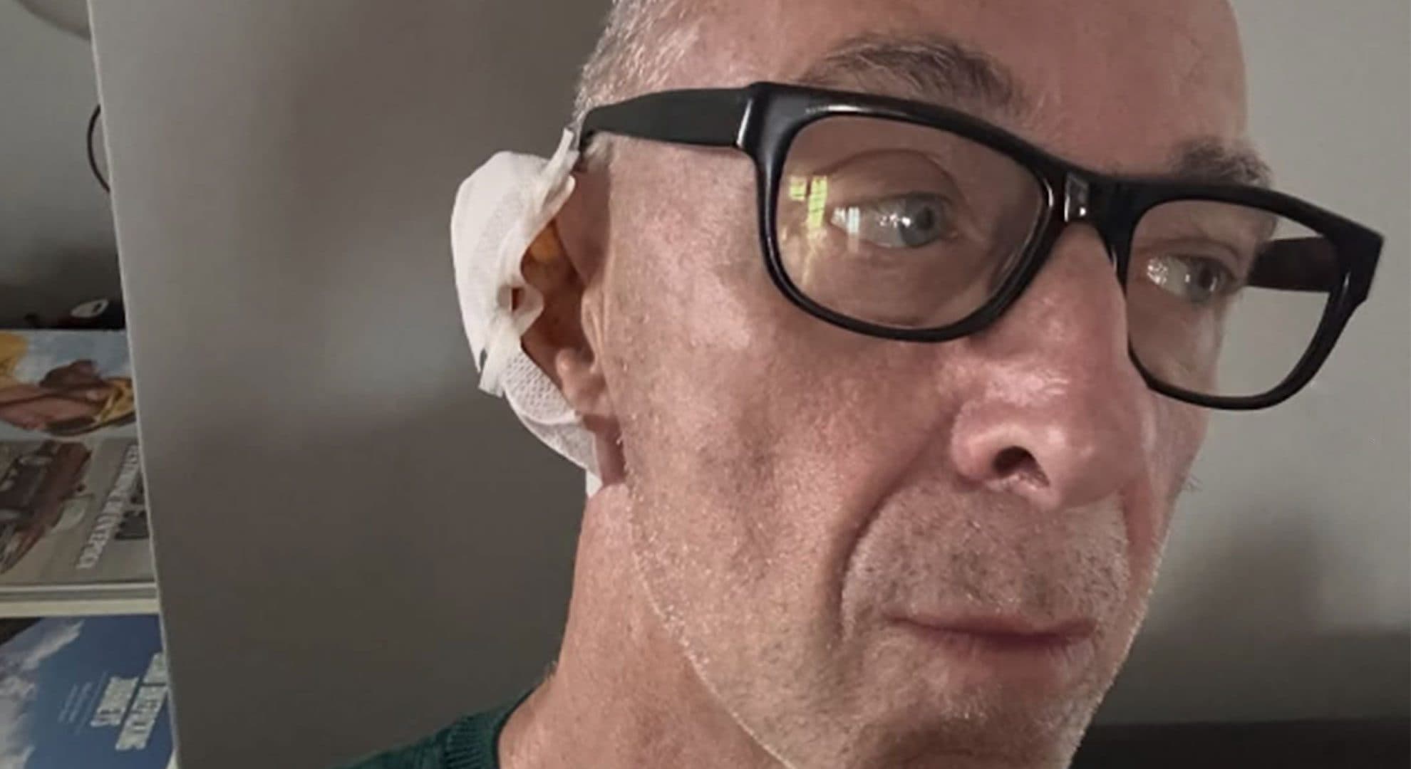 Cos’è l’epitelioma, il tumore della pelle per cui Linus è stato operato: sintomi, cause e cure