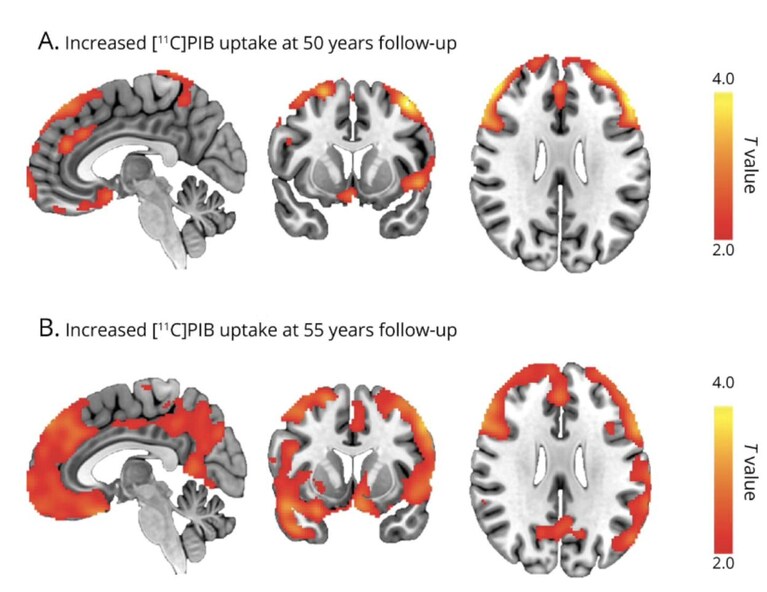 Credits: Progression of Amyloid Accumulation in Late Adulthood Among People With Childhood-Onset Epilepsy - Neurology