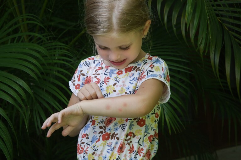 bimba con punture di insetto