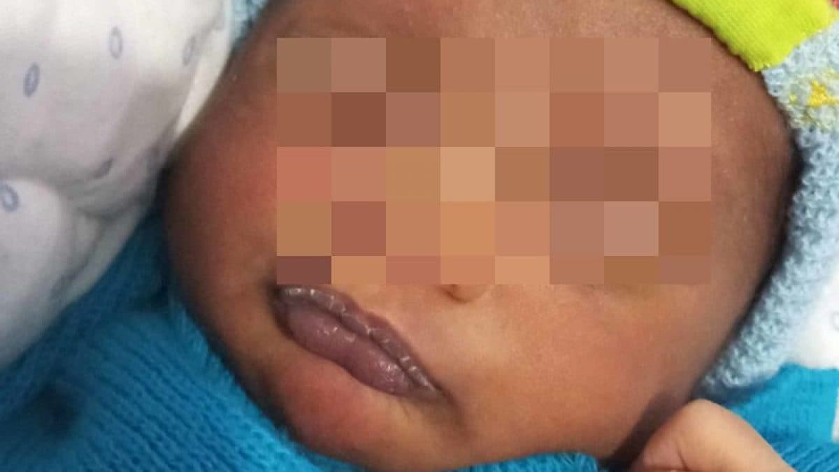 Credits: "Sucking Pads: A Report of Two Newborns"; Cureus; Thadchanamoorthy V, Thirukumar M, Dayasiri K.