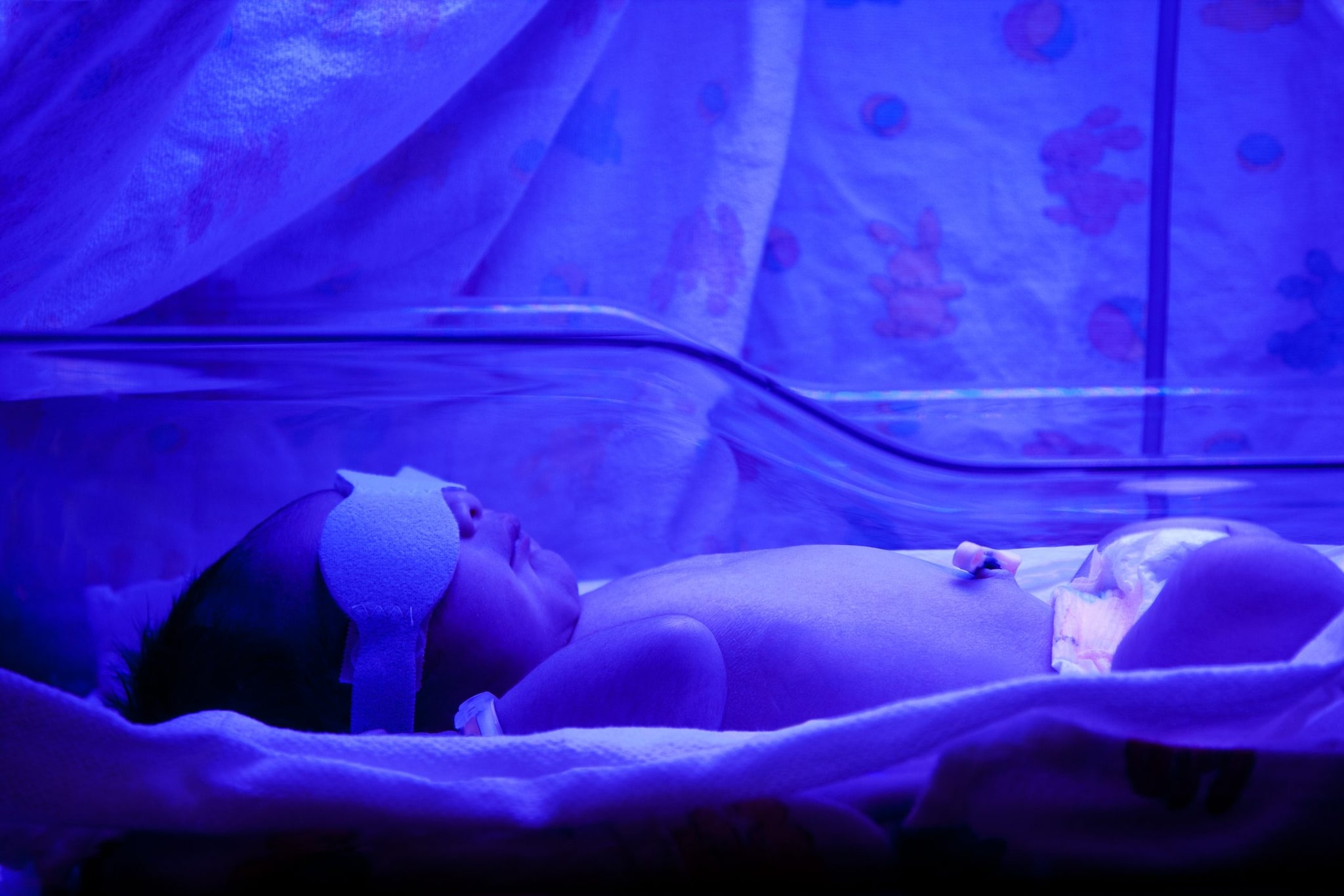 La luce blu è una pratica standard per trattare l’ittero nei neonati. Immagine di repertorio
