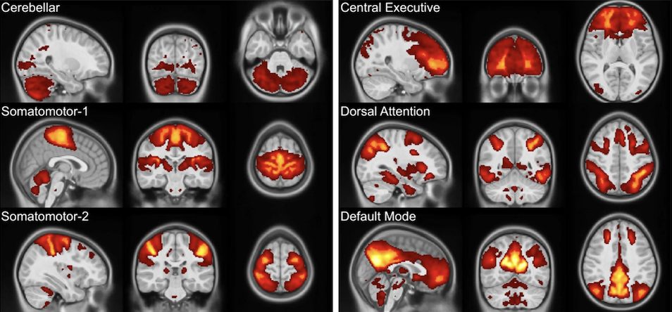 Immagine di una risonanza magnetica effettuata sui giovani partecipanti allo studio. Credits: Journal of Neurodevelopmental Disorders 