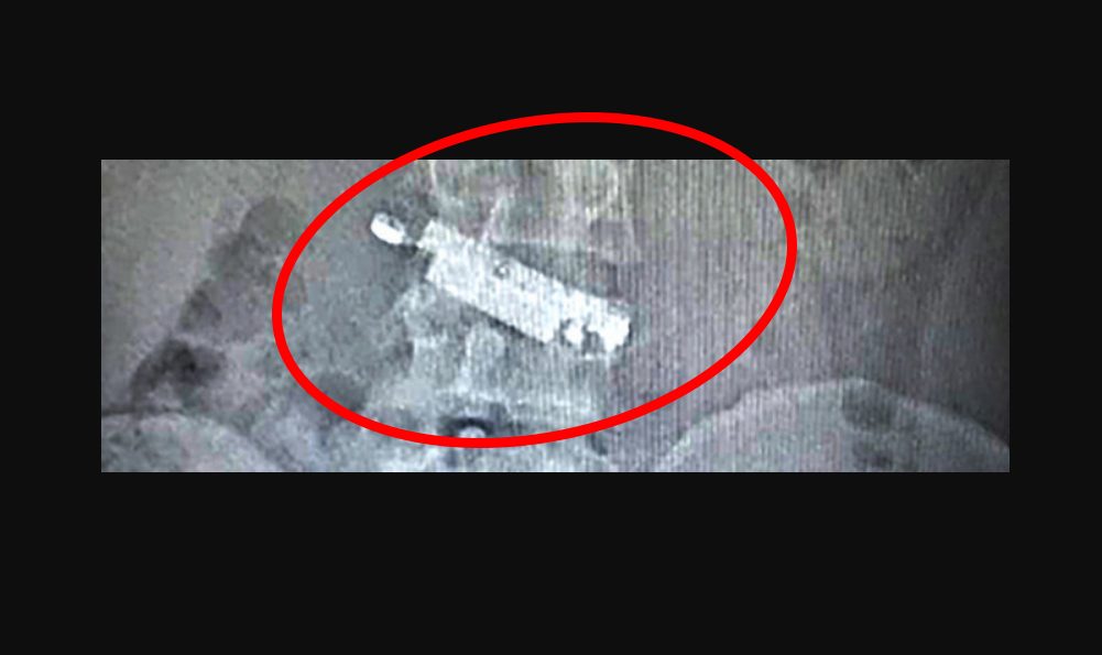 La radiografia del detenuto a Napoli che mostra il cellulare ingoiato
