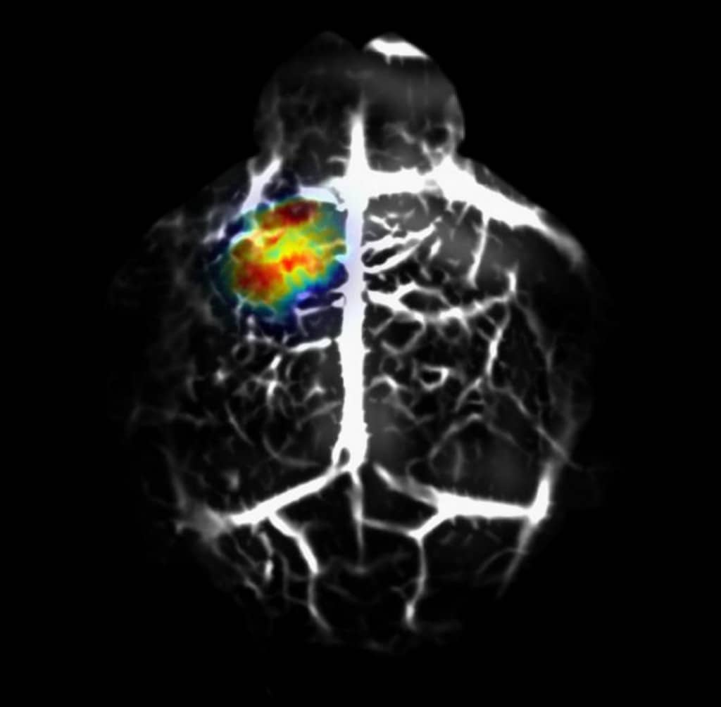 Come Capire Se Hai Un Tumore Al Cervello