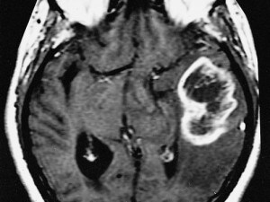 Glioblastoma