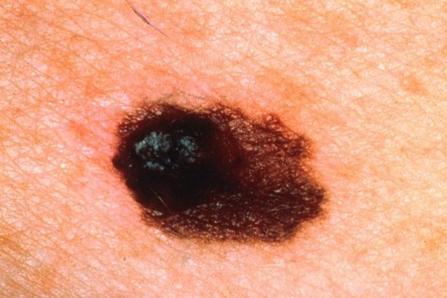melanoma-638x425
