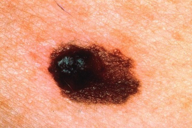 melanoma-638x425-638x425