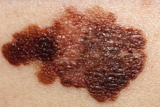 Un melanoma