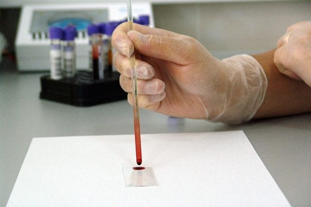 Test del sangue sperimentale identifica cinque tumori con 4 anni di anticipo