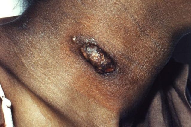 Lesione da coccidiomicosi. Credit: CDC/ Dr. Lucille K. Georg
