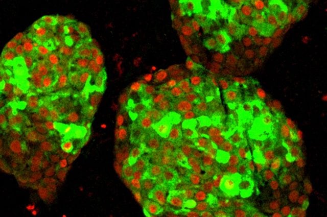 Diabete, cellule mature che producono insulina create per la prima volta: traguardo storico