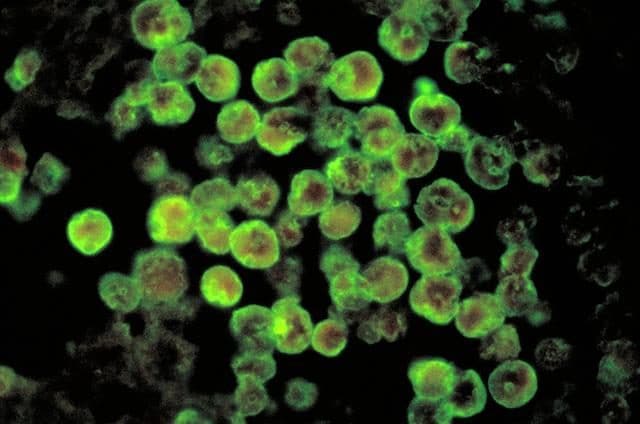 Credit <a href="https://it.wikipedia.org/wiki/Naegleria_fowleri#/media/File:M%C3%A9ningo–enc%C3%A9phalite_amibienne_primitive.JPGhttps://it.wikipedia.org/wiki/Naegleria_fowleri#/media/File:M%C3%A9ningo–enc%C3%A9phalite_amibienne_primitive.JPG" target="_blank" rel="nofollow noopener">Wikipedia</a>