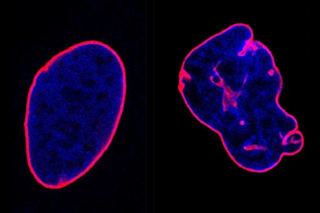 A destra il nucleo delle cellule di un paziente con gene HIST1H1E mutato Credit: Ospedale Bambin Gesù/Marco Tartaglia
