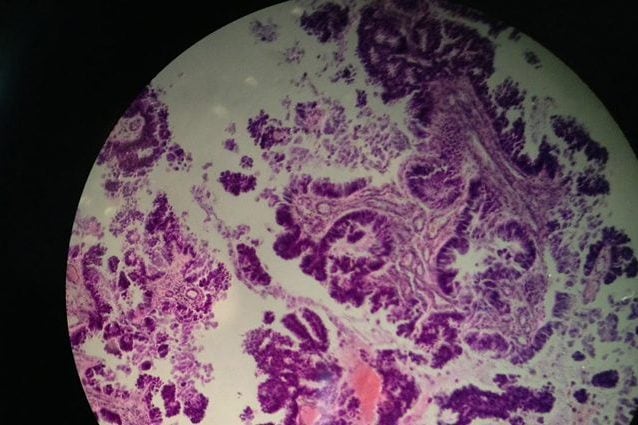Metastasi al cervello di un tumore primario all’intestino. Credit: Wikimedia Commons
