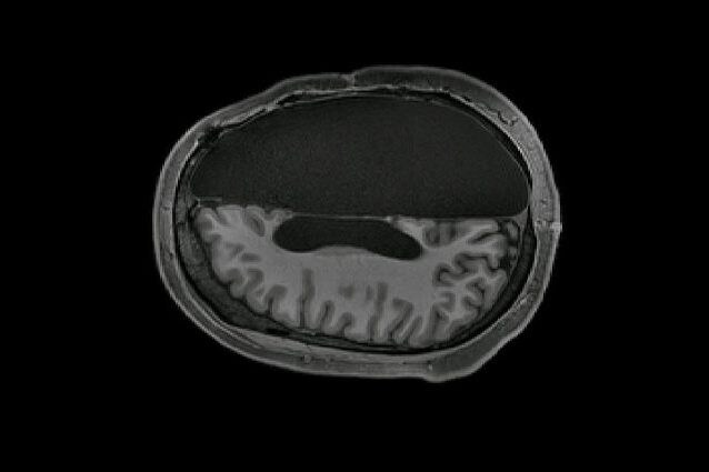 La scansione della testa di una persona con metà cervello. Credit: Caltech Brain Imaging Center