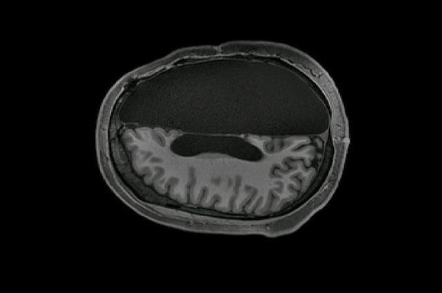 La scansione della testa di una persona con metà cervello. Credit: Caltech Brain Imaging Center