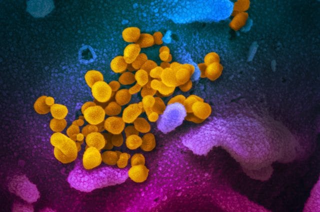 In giallo le particelle virali del coronavirus, in blu e viola le strutture della cellula invasa. Credit: