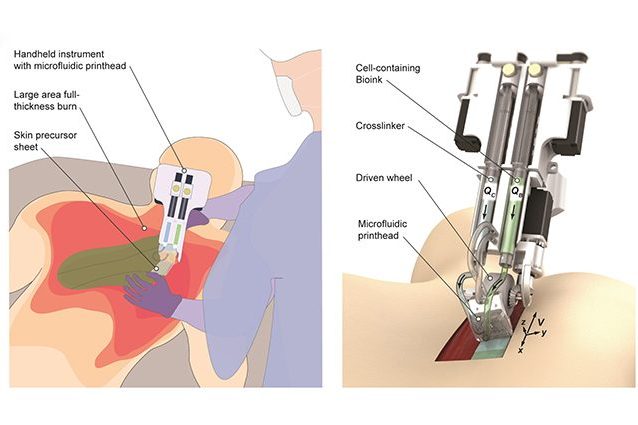 Illustrazione che mostra il funzionamento del dispositivo cura–ustioni. Credit: IOP