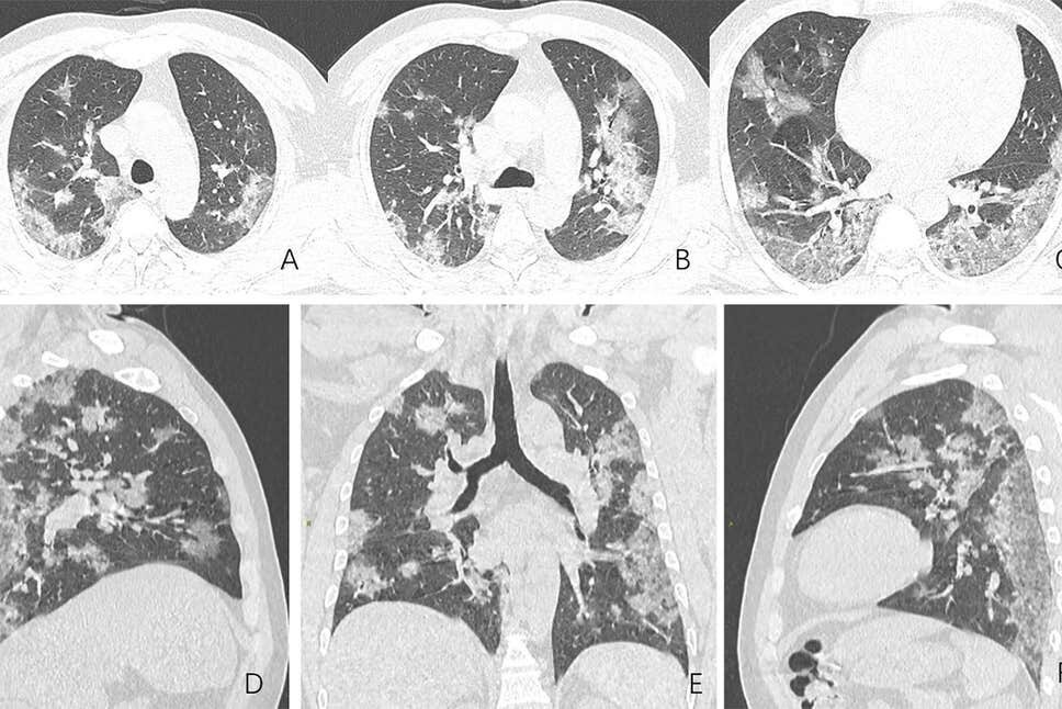 Così il coronavirus colpisce i polmoni dei malati