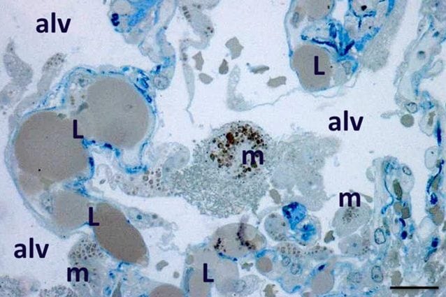I segni dell’embolia grassosa nel tessuto polmonare di un paziente deceduto a causa del coronavirus. Credit: International Journal of Obesity
