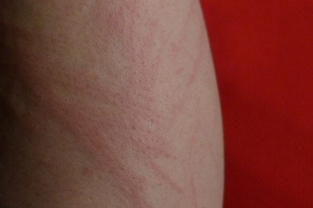 Un’eruzione cutanea sul braccio