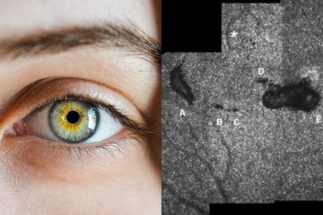 A destra, le lesioni causate dal laser – visibili come macchine nere – sulla retina del giovane. Credit: Wolters Kluwer Health, Inc.