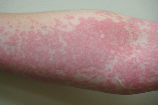 Orticaria. Credit: James Heilman